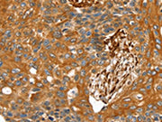 The image on the left is immunohistochemistry of paraffin-embedded Human esophagus cancer tissue using CSB-PA180088(TAGLN Antibody) at dilution 1/30, on the right is treated with fusion protein. (Original magnification: ×200)
