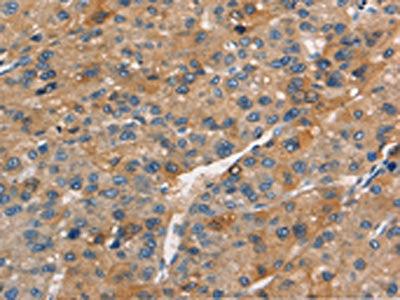 The image on the left is immunohistochemistry of paraffin-embedded Human liver cancer tissue using CSB-PA180634(APOC4 Antibody) at dilution 1/15, on the right is treated with synthetic peptide. (Original magnification: ×200)