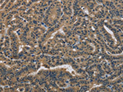 The image on the left is immunohistochemistry of paraffin-embedded Human thyroid cancer tissue using CSB-PA180704(DNAJA1 Antibody) at dilution 1/30, on the right is treated with fusion protein. (Original magnification: ×200)