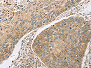 The image on the left is immunohistochemistry of paraffin-embedded Human esophagus cancer tissue using CSB-PA180985(SCAP Antibody) at dilution 1/20, on the right is treated with fusion protein. (Original magnification: ×200)