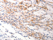 The image on the left is immunohistochemistry of paraffin-embedded Human lung cancer tissue using CSB-PA181038(KRT6A/KRT6B/KRT6C Antibody) at dilution 1/40, on the right is treated with synthetic peptide. (Original magnification: ×200)