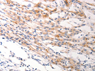 The image on the left is immunohistochemistry of paraffin-embedded Human lung cancer tissue using CSB-PA181038(KRT6A/KRT6B/KRT6C Antibody) at dilution 1/40, on the right is treated with synthetic peptide. (Original magnification: ×200)