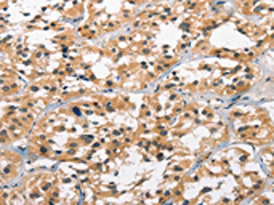 The image on the left is immunohistochemistry of paraffin-embedded Human thyroid cancer tissue using CSB-PA181048(GPR182 Antibody) at dilution 1/30, on the right is treated with synthetic peptide. (Original magnification: ×200)