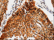 The image is immunohistochemistry of paraffin-embedded Human cervical cancer tissue using CSB-PA181054(ABCB5 Antibody) at dilution 1/10. (Original magnification: ×200)