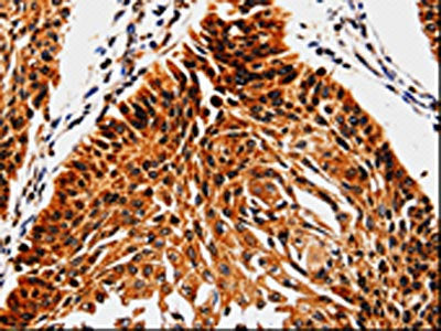 The image is immunohistochemistry of paraffin-embedded Human cervical cancer tissue using CSB-PA181054(ABCB5 Antibody) at dilution 1/10. (Original magnification: ×200)