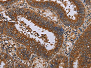 The image on the left is immunohistochemistry of paraffin-embedded Human colon cancer tissue using CSB-PA181075(NPTX1 Antibody) at dilution 1/50, on the right is treated with synthetic peptide. (Original magnification: ×200)