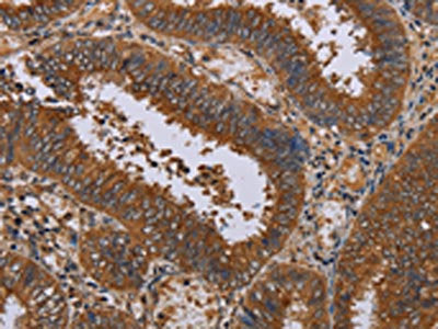 The image on the left is immunohistochemistry of paraffin-embedded Human colon cancer tissue using CSB-PA181075(NPTX1 Antibody) at dilution 1/50, on the right is treated with synthetic peptide. (Original magnification: ×200)
