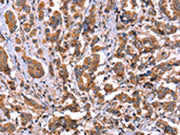 The image on the left is immunohistochemistry of paraffin-embedded Human breast cancer tissue using CSB-PA181107(HRG Antibody) at dilution 1/50, on the right is treated with synthetic peptide. (Original magnification: ×200)