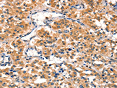 The image on the left is immunohistochemistry of paraffin-embedded Human thyroid cancer tissue using CSB-PA181130(AIMP1 Antibody) at dilution 1/40, on the right is treated with synthetic peptide. (Original magnification: ×200)