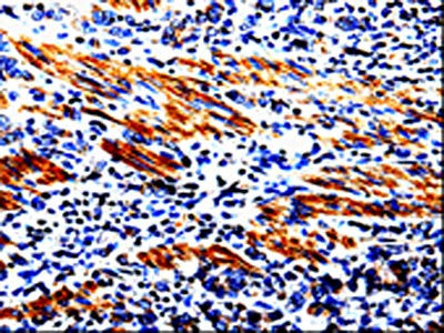 The image on the left is immunohistochemistry of paraffin-embedded Human stomach cancer tissue using CSB-PA181186(ACSBG2 Antibody) at dilution 1/60, on the right is treated with fusion protein. (Original magnification: ×200)