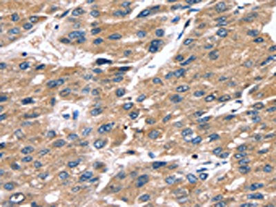 The image on the left is immunohistochemistry of paraffin-embedded Human liver cancer tissue using CSB-PA181261(SRGN Antibody) at dilution 1/25, on the right is treated with fusion protein. (Original magnification: ×200)
