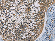 The image on the left is immunohistochemistry of paraffin-embedded Human cervical cancer tissue using CSB-PA181338(CSNK1E Antibody) at dilution 1/60, on the right is treated with fusion protein. (Original magnification: ×200)