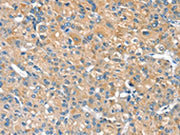 The image on the left is immunohistochemistry of paraffin-embedded Human liver cancer tissue using CSB-PA181515(PILRB Antibody) at dilution 1/20, on the right is treated with fusion protein. (Original magnification: ×200)