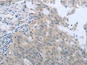 The image on the left is immunohistochemistry of paraffin-embedded Human breast cancer tissue using CSB-PA181605(TNK2 Antibody) at dilution 1/70, on the right is treated with synthetic peptide. (Original magnification: ×200)
