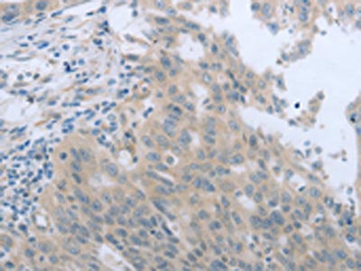 The image on the left is immunohistochemistry of paraffin-embedded Human breast cancer tissue using CSB-PA181605(TNK2 Antibody) at dilution 1/70, on the right is treated with synthetic peptide. (Original magnification: ×200)