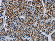 The image is immunohistochemistry of paraffin-embedded Human liver cancer tissue using CSB-PA181854(SAR1B Antibody) at dilution 1/20. (Original magnification: ×200)