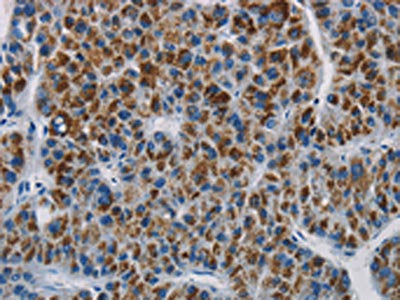 The image is immunohistochemistry of paraffin-embedded Human liver cancer tissue using CSB-PA181854(SAR1B Antibody) at dilution 1/20. (Original magnification: ×200)