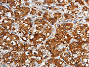 The image on the left is immunohistochemistry of paraffin-embedded Human breast cancer tissue using CSB-PA181894(GGCX Antibody) at dilution 1/60, on the right is treated with fusion protein. (Original magnification: ×200)