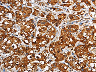 The image on the left is immunohistochemistry of paraffin-embedded Human breast cancer tissue using CSB-PA181894(GGCX Antibody) at dilution 1/60, on the right is treated with fusion protein. (Original magnification: ×200)