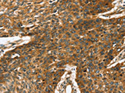 The image on the left is immunohistochemistry of paraffin-embedded Human esophagus cancer tissue using CSB-PA182372(TRPV5 Antibody) at dilution 1/35, on the right is treated with synthetic peptide. (Original magnification: ×200)