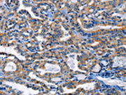 The image on the left is immunohistochemistry of paraffin-embedded Human thyroid cancer tissue using CSB-PA182384(HCK Antibody) at dilution 1/20, on the right is treated with fusion protein. (Original magnification: ×200)