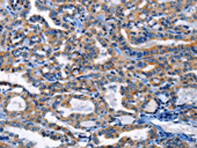 The image on the left is immunohistochemistry of paraffin-embedded Human thyroid cancer tissue using CSB-PA182384(HCK Antibody) at dilution 1/20, on the right is treated with fusion protein. (Original magnification: ×200)