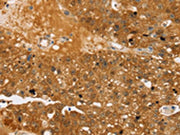 The image on the left is immunohistochemistry of paraffin-embedded Human breast cancer tissue using CSB-PA182529(TBC1D4 Antibody) at dilution 1/40, on the right is treated with synthetic peptide. (Original magnification: ×200)