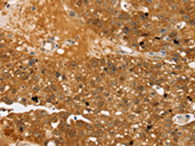 The image on the left is immunohistochemistry of paraffin-embedded Human breast cancer tissue using CSB-PA182529(TBC1D4 Antibody) at dilution 1/40, on the right is treated with synthetic peptide. (Original magnification: ×200)