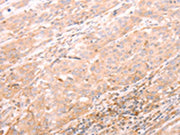 The image on the left is immunohistochemistry of paraffin-embedded Human esophagus cancer tissue using CSB-PA182593(ALPPL2 Antibody) at dilution 1/20, on the right is treated with synthetic peptide. (Original magnification: ×200)