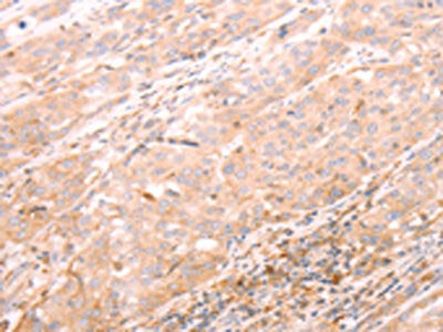 The image on the left is immunohistochemistry of paraffin-embedded Human esophagus cancer tissue using CSB-PA182593(ALPPL2 Antibody) at dilution 1/20, on the right is treated with synthetic peptide. (Original magnification: ×200)