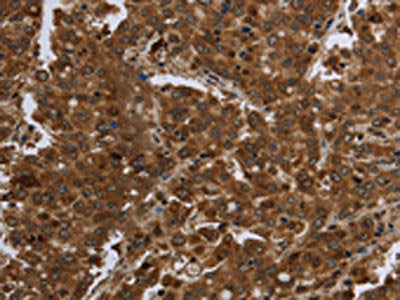 The image on the left is immunohistochemistry of paraffin-embedded Human liver cancer tissue using CSB-PA182654(FASTKD1 Antibody) at dilution 1/60, on the right is treated with fusion protein. (Original magnification: ×200)
