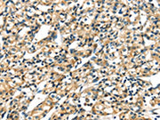 The image on the left is immunohistochemistry of paraffin-embedded Human prostate cancer tissue using CSB-PA182687(KRT17 Antibody) at dilution 1/40, on the right is treated with fusion protein. (Original magnification: ×200)