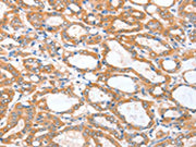 The image on the left is immunohistochemistry of paraffin-embedded Human thyroid cancer tissue using CSB-PA182772(ACSBG1 Antibody) at dilution 1/25, on the right is treated with fusion protein. (Original magnification: ×200)