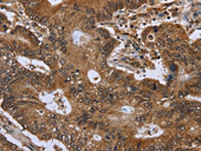The image on the left is immunohistochemistry of paraffin-embedded Human colon cancer tissue using CSB-PA182810(FHIT Antibody) at dilution 1/30, on the right is treated with fusion protein. (Original magnification: ×200)