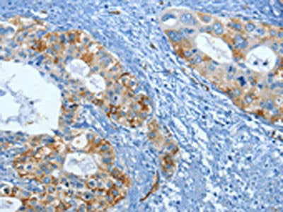 The image on the left is immunohistochemistry of paraffin-embedded Human cervical cancer tissue using CSB-PA182867(FSCN1 Antibody) at dilution 1/20, on the right is treated with fusion protein. (Original magnification: ×200)