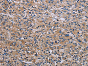 The image on the left is immunohistochemistry of paraffin-embedded Human prostate cancer tissue using CSB-PA182949(RPS6KB2 Antibody) at dilution 1/40, on the right is treated with synthetic peptide. (Original magnification: ×200)