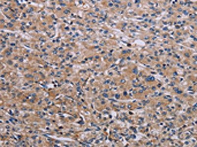The image on the left is immunohistochemistry of paraffin-embedded Human prostate cancer tissue using CSB-PA182949(RPS6KB2 Antibody) at dilution 1/40, on the right is treated with synthetic peptide. (Original magnification: ×200)