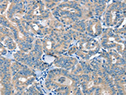 The image on the left is immunohistochemistry of paraffin-embedded Human thyroid cancer tissue using CSB-PA183005(SEPN1 Antibody) at dilution 1/20, on the right is treated with synthetic peptide. (Original magnification: ×200)