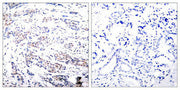 Immunohistochemical analysis of paraffin-embedded human breast carcinoma tissue using Elk-1(Ab-383) Antibody(left) or the same antibody preincubated with blocking peptide(right).