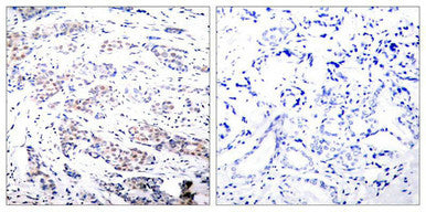 Immunohistochemical analysis of paraffin-embedded human breast carcinoma tissue using Elk-1(Ab-383) Antibody(left) or the same antibody preincubated with blocking peptide(right).