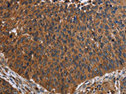 The image on the left is immunohistochemistry of paraffin-embedded Human lung cancer tissue using CSB-PA183080(FCGR3A Antibody) at dilution 1/60, on the right is treated with fusion protein. (Original magnification: ×200)