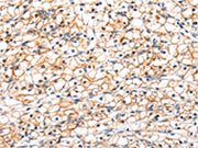 The image on the left is immunohistochemistry of paraffin-embedded Human renal cancer tissue using CSB-PA183226(GLP1R Antibody) at dilution 1/20, on the right is treated with fusion protein. (Original magnification: ×200)
