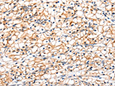 The image on the left is immunohistochemistry of paraffin-embedded Human renal cancer tissue using CSB-PA183226(GLP1R Antibody) at dilution 1/20, on the right is treated with fusion protein. (Original magnification: ×200)