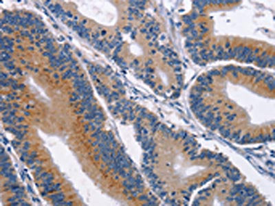 The image on the left is immunohistochemistry of paraffin-embedded Human colon cancer tissue using CSB-PA183273(CD48 Antibody) at dilution 1/40, on the right is treated with synthetic peptide. (Original magnification: ×200)
