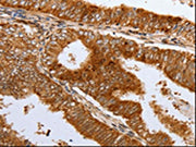 The image on the left is immunohistochemistry of paraffin-embedded Human cervical cancer tissue using CSB-PA183398(DNMT1 Antibody) at dilution 1/12, on the right is treated with synthetic peptide. (Original magnification: ×200)