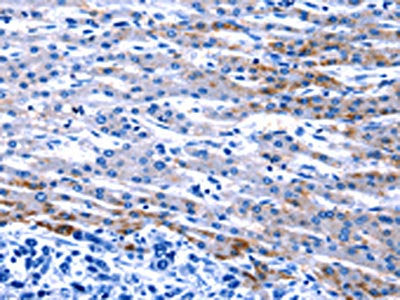 The image on the left is immunohistochemistry of paraffin-embedded Human liver cancer tissue using CSB-PA183460(FOXJ1 Antibody) at dilution 1/20, on the right is treated with synthetic peptide. (Original magnification: ×200)