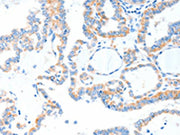 The image on the left is immunohistochemistry of paraffin-embedded Human thyroid cancer tissue using CSB-PA183593(TLR2 Antibody) at dilution 1/55, on the right is treated with fusion protein. (Original magnification: ×200)