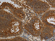 The image on the left is immunohistochemistry of paraffin-embedded Human colon cancer tissue using CSB-PA183860(KCNK17 Antibody) at dilution 1/50, on the right is treated with fusion protein. (Original magnification: ×200)