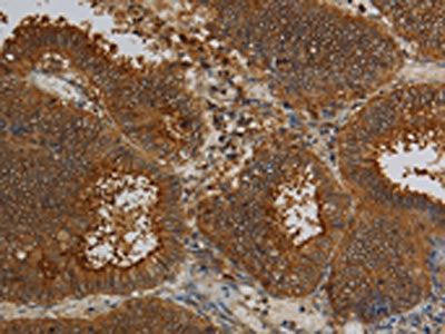 The image on the left is immunohistochemistry of paraffin-embedded Human colon cancer tissue using CSB-PA183860(KCNK17 Antibody) at dilution 1/50, on the right is treated with fusion protein. (Original magnification: ×200)