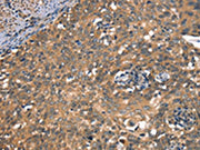 The image on the left is immunohistochemistry of paraffin-embedded Human cervical cancer tissue using CSB-PA184126(DAAM1 Antibody) at dilution 1/50, on the right is treated with synthetic peptide. (Original magnification: ×200)